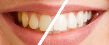 differenza tra denti gialli e bianchi